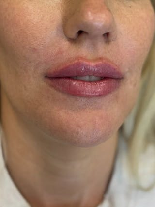 Lip Filler Before & After Gallery - Patient 229122 - Image 4
