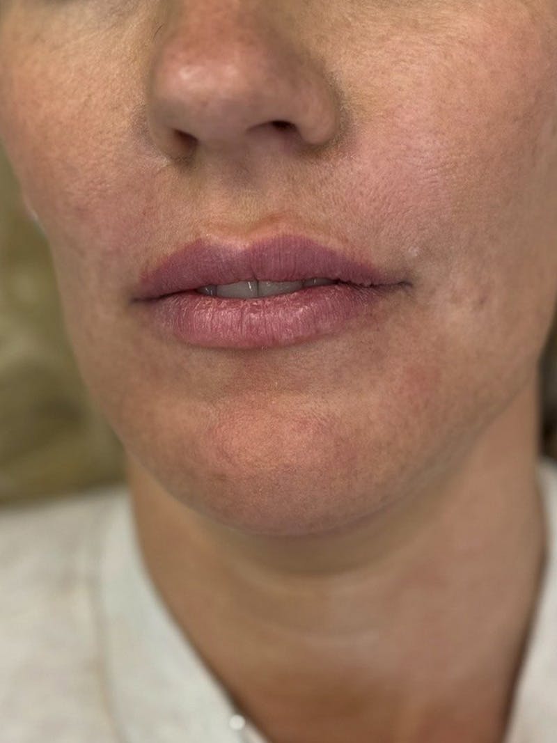 Lip Filler Before & After Gallery - Patient 229122 - Image 5