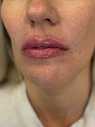 Lip Filler Before & After Gallery - Patient 229122 - Image 6