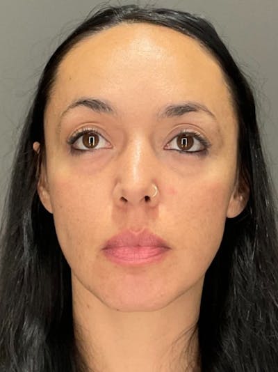 Tear Trough Before & After Gallery - Patient 204829 - Image 1