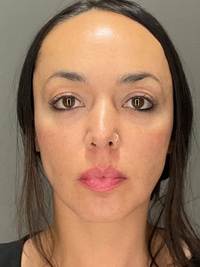 Tear Trough Before & After Gallery - Patient 204829 - Image 2