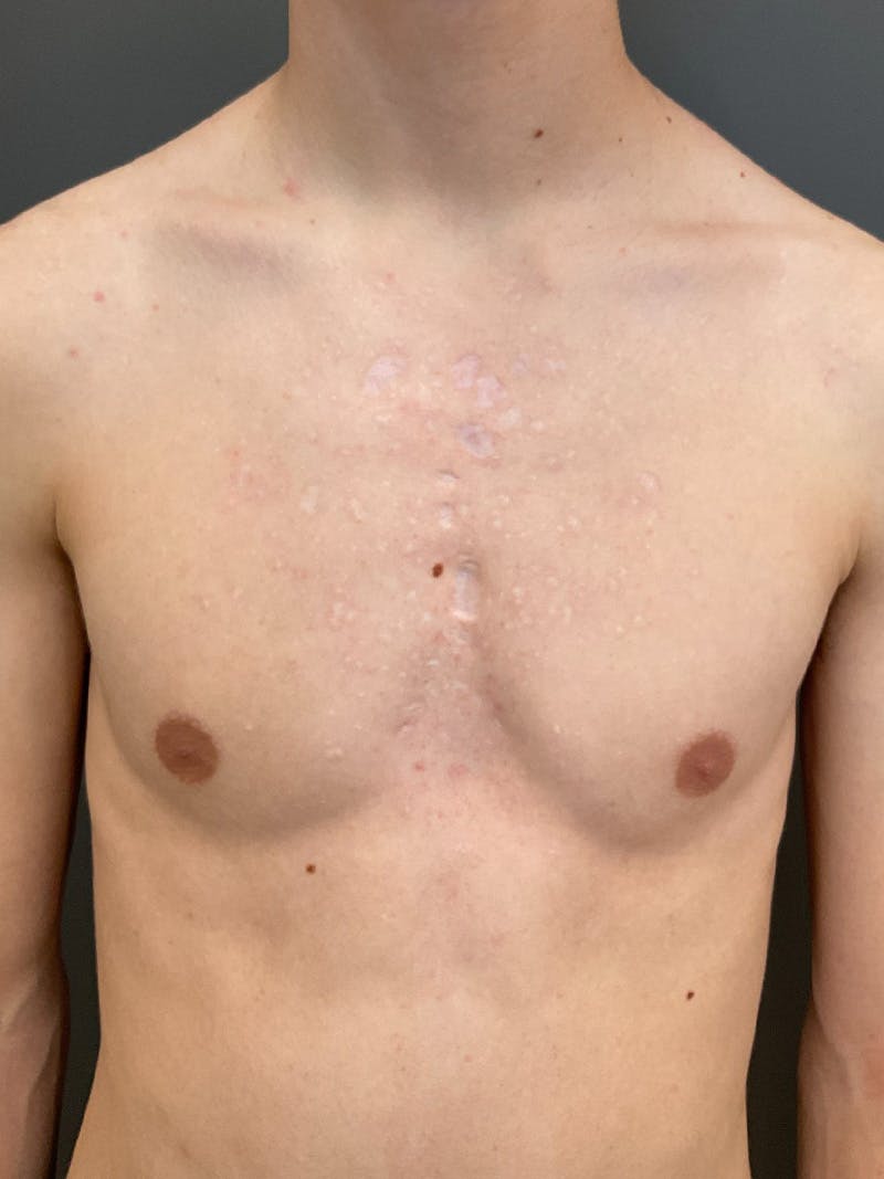Laser Treatment Before & After Gallery - Patient 386985 - Image 1