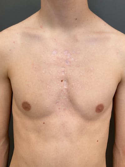 Laser Treatment Before & After Gallery - Patient 386985 - Image 1