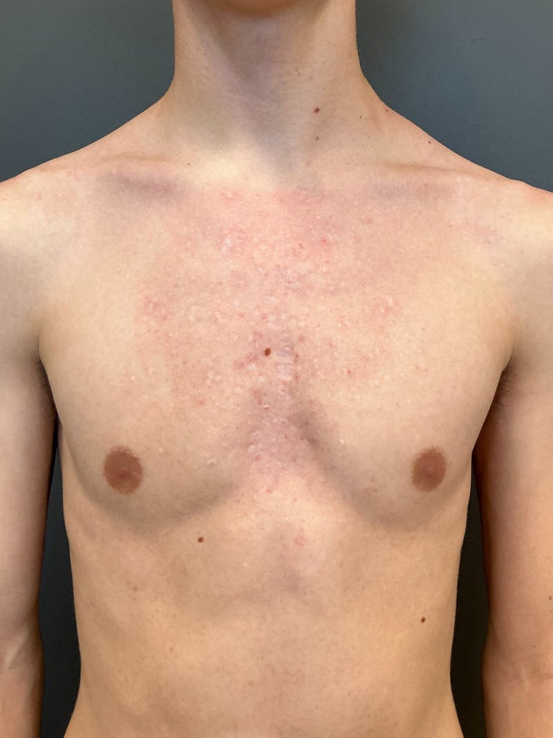 Laser Treatment Before & After Gallery - Patient 386985 - Image 2