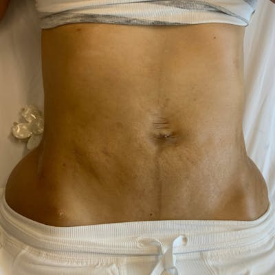 Microneedling Treatment Before & After Gallery - Patient 310126 - Image 1