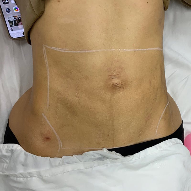 Microneedling Treatment Before & After Gallery - Patient 310126 - Image 2