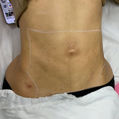 Microneedling Treatment Before & After Gallery - Patient 310126 - Image 2