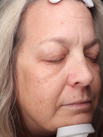 Skin Care Protocol Before & After Gallery - Patient 959086 - Image 1
