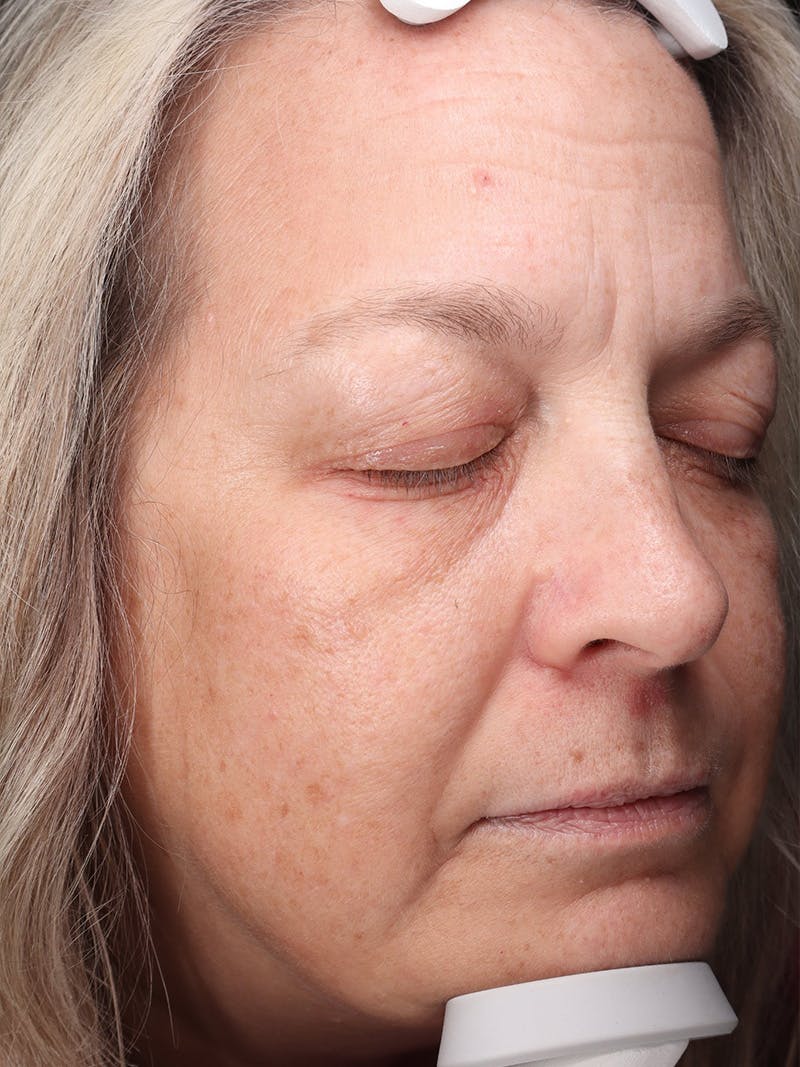 Skin Care Protocol Before & After Gallery - Patient 959086 - Image 1