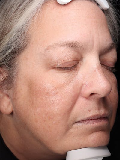 Skin Care Protocol Before & After Gallery - Patient 959086 - Image 2