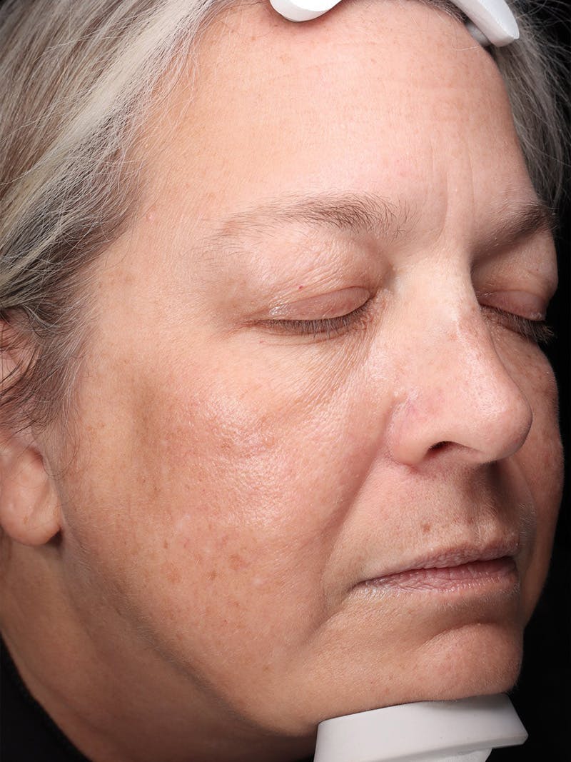 Skin Care Protocol Before & After Gallery - Patient 959086 - Image 2