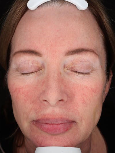 Laser Treatment Before & After Gallery - Patient 872021 - Image 1