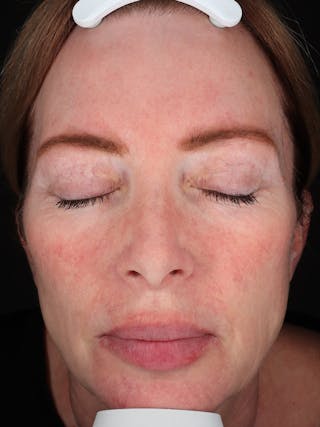Laser Treatment Before & After Gallery - Patient 872021 - Image 2