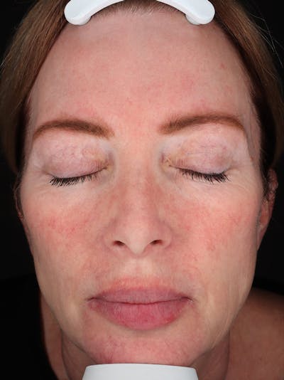 Laser Treatment Before & After Gallery - Patient 872021 - Image 2