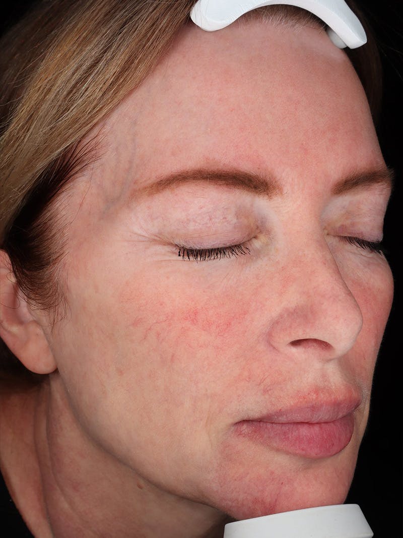 Laser Treatment Before & After Gallery - Patient 872021 - Image 3