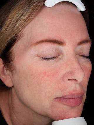 Laser Treatment Before & After Gallery - Patient 872021 - Image 4