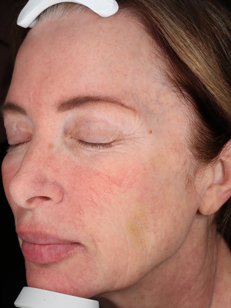 Laser Treatment Before & After Gallery - Patient 872021 - Image 5