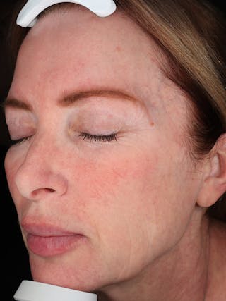 Laser Treatment Before & After Gallery - Patient 872021 - Image 6