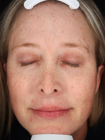 Laser Treatment Before & After Gallery - Patient 327968 - Image 1