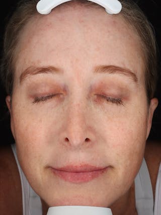 Laser Treatment Before & After Gallery - Patient 327968 - Image 2