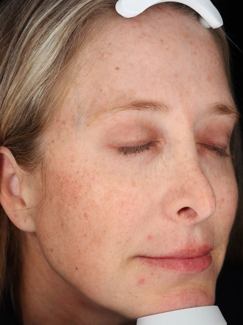 Laser Treatment Before & After Gallery - Patient 327968 - Image 3