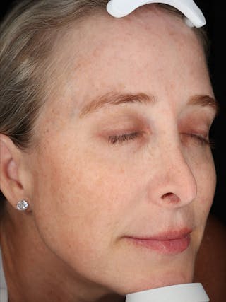 Laser Treatment Before & After Gallery - Patient 327968 - Image 4