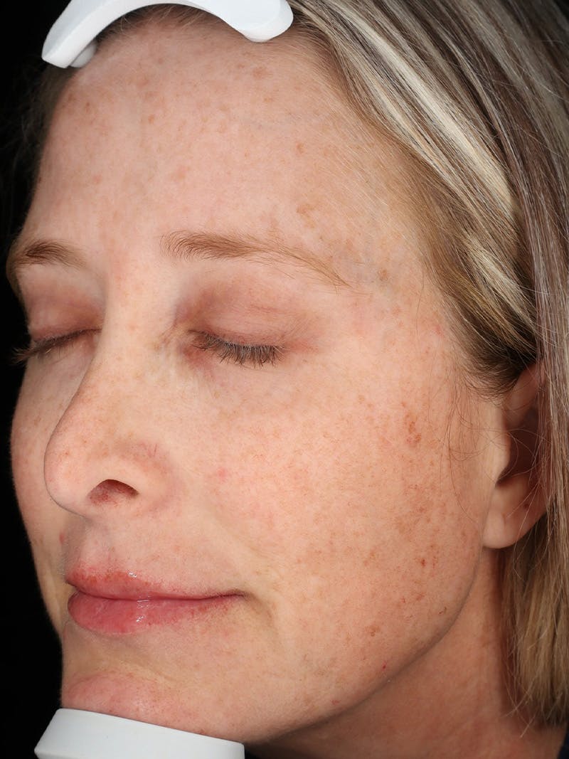 Laser Treatment Before & After Gallery - Patient 327968 - Image 5
