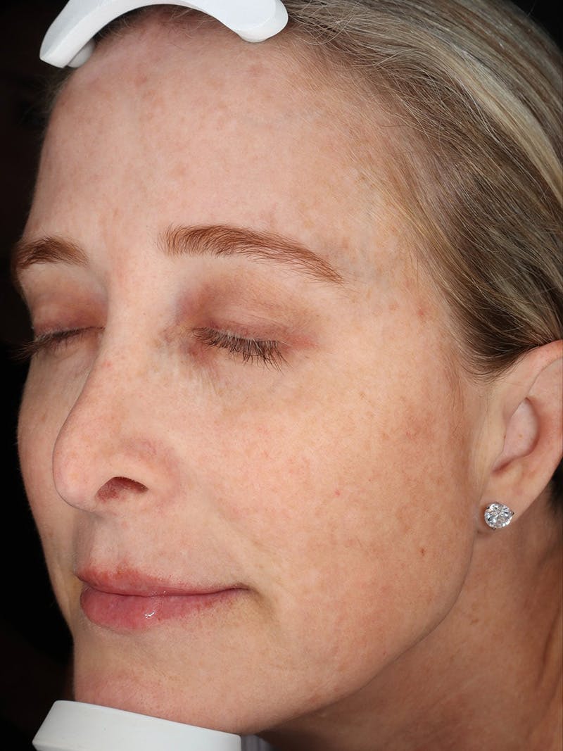 Laser Treatment Before & After Gallery - Patient 327968 - Image 6
