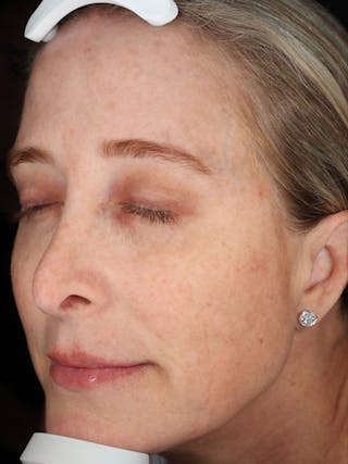 Laser Treatment Before & After Gallery - Patient 327968 - Image 6