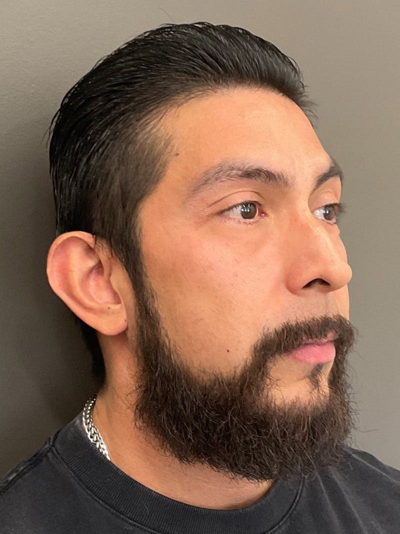 Tear Trough Before & After Gallery - Patient 197024 - Image 3