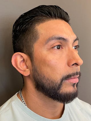 Tear Trough Before & After Gallery - Patient 197024 - Image 4