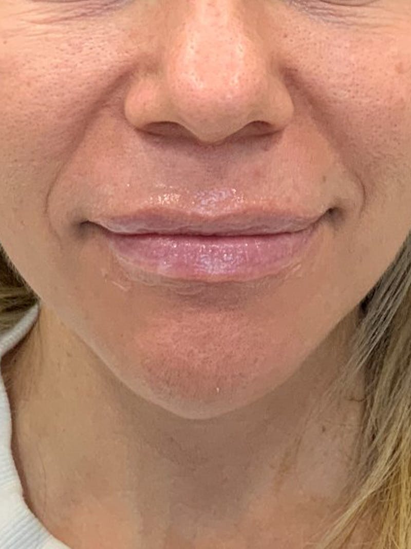 Lip Filler Before & After Gallery - Patient 922945 - Image 1