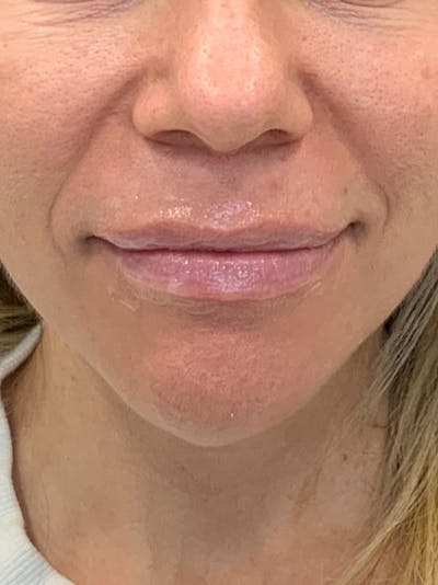 Lip Filler Before & After Gallery - Patient 922945 - Image 1