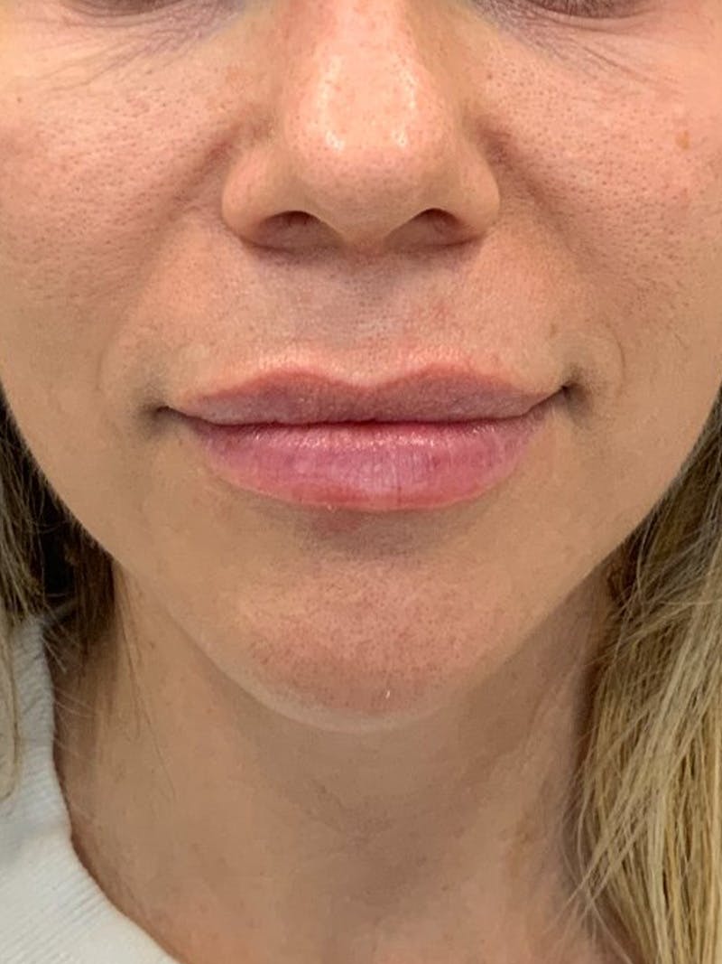 Lip Filler Before & After Gallery - Patient 922945 - Image 2
