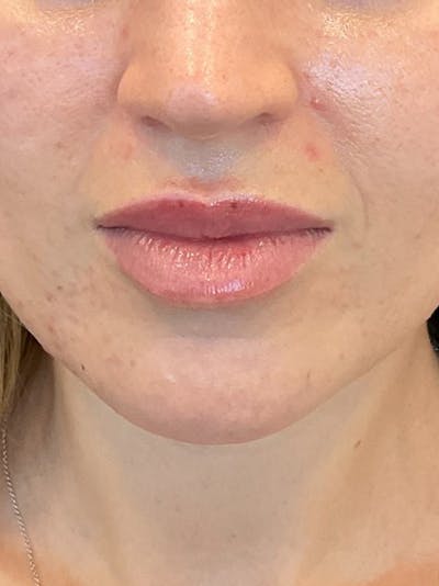 Lip Filler Before & After Gallery - Patient 406272 - Image 1