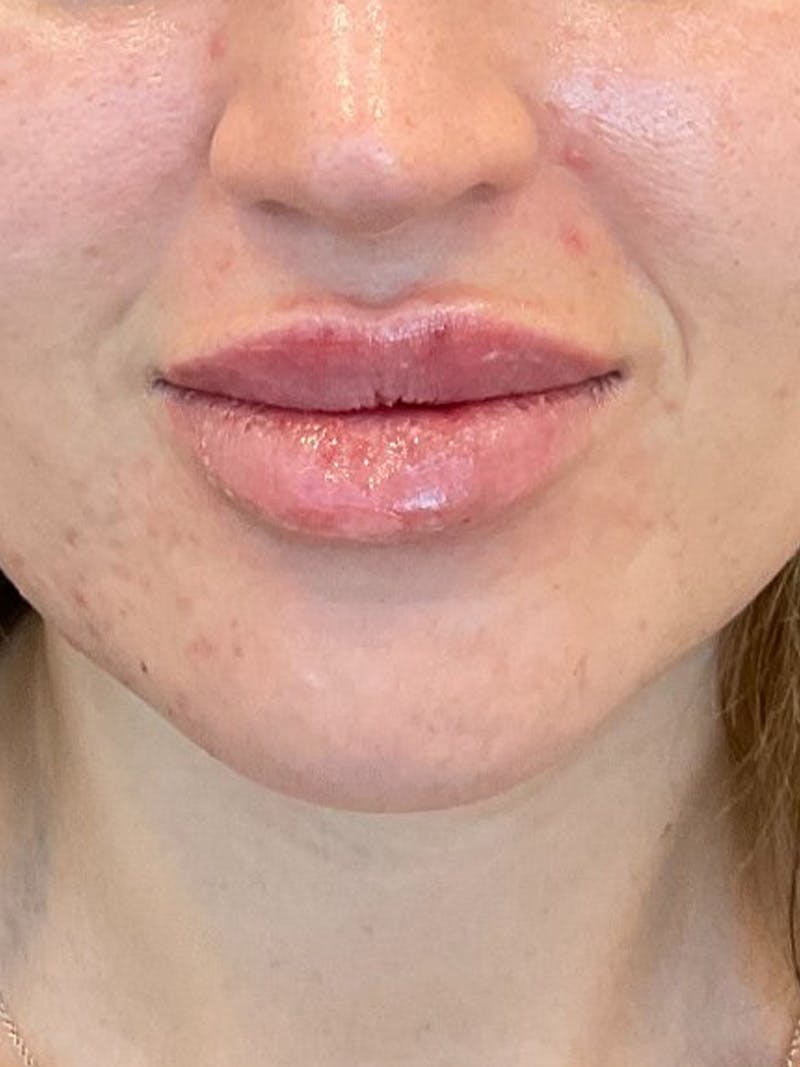 Lip Filler Before & After Gallery - Patient 406272 - Image 2