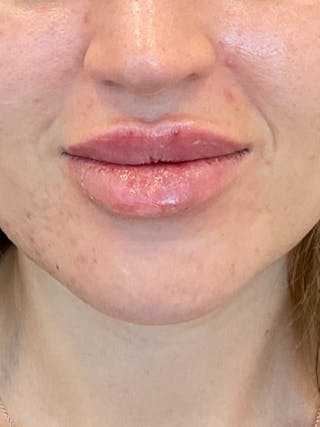 Lip Filler Before & After Gallery - Patient 406272 - Image 2