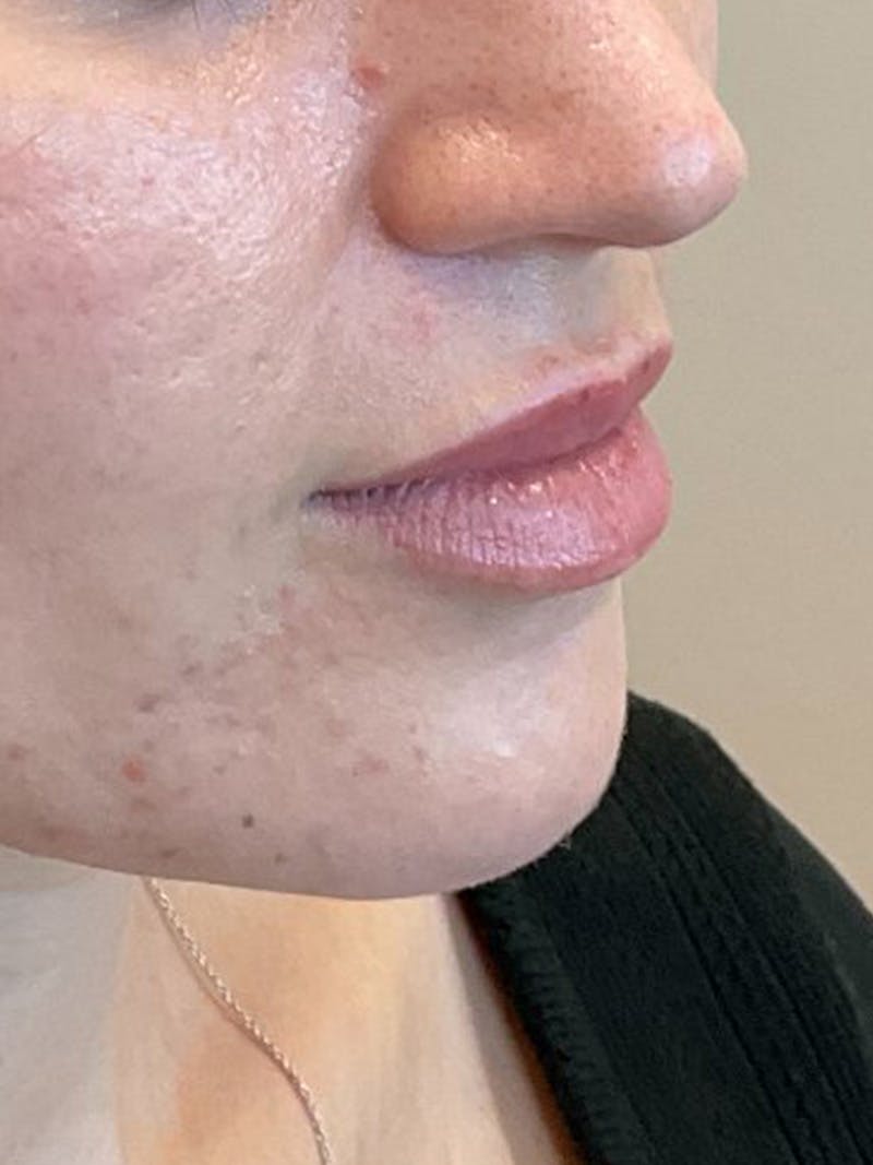 Lip Filler Before & After Gallery - Patient 406272 - Image 3