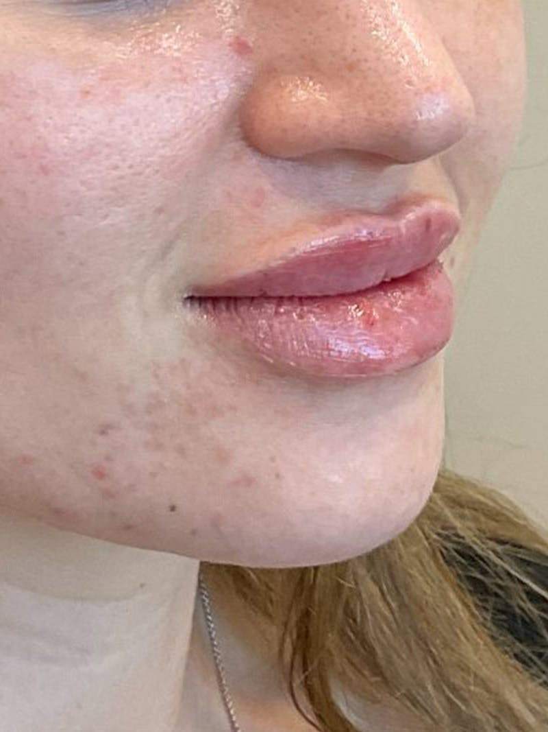 Lip Filler Before & After Gallery - Patient 406272 - Image 4