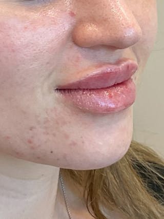 Lip Filler Before & After Gallery - Patient 406272 - Image 4