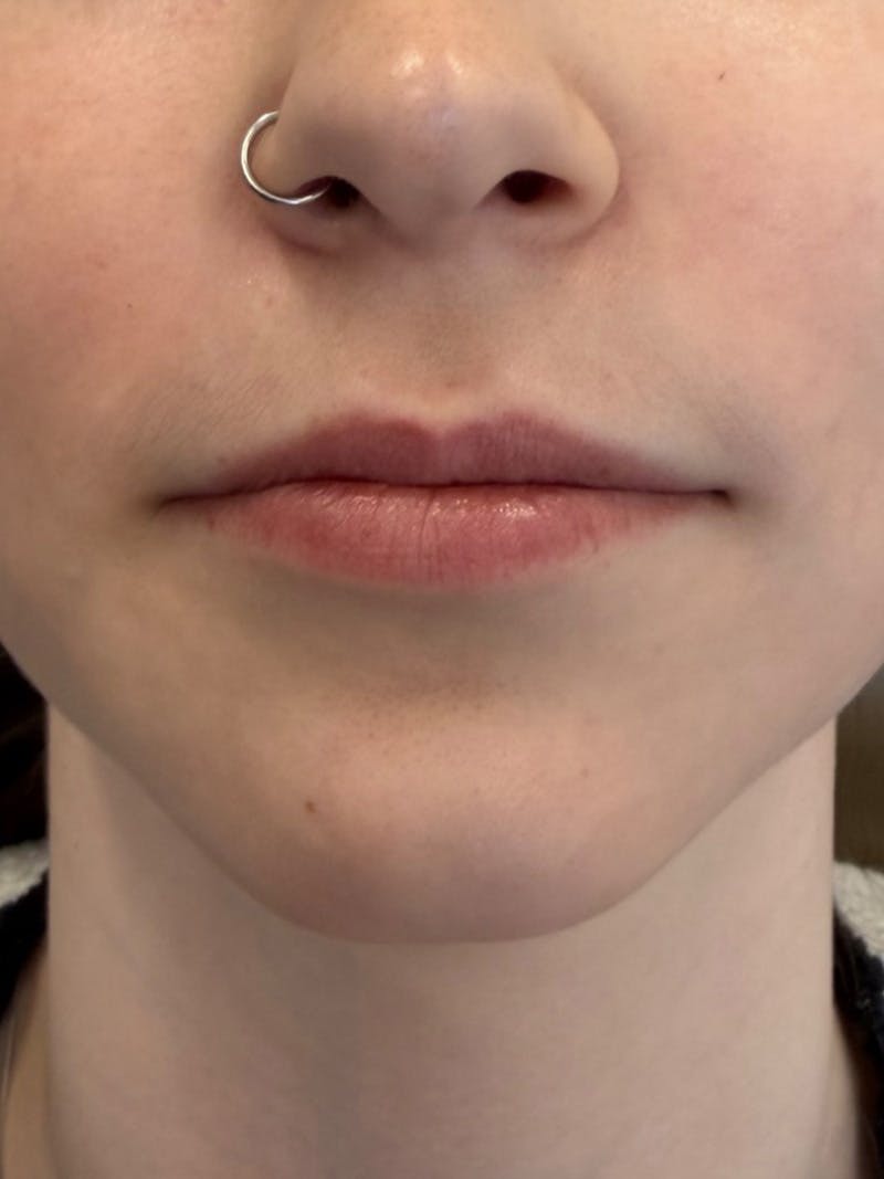 Lip Filler Before & After Gallery - Patient 740998 - Image 1