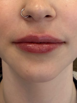 Lip Filler Before & After Gallery - Patient 740998 - Image 2