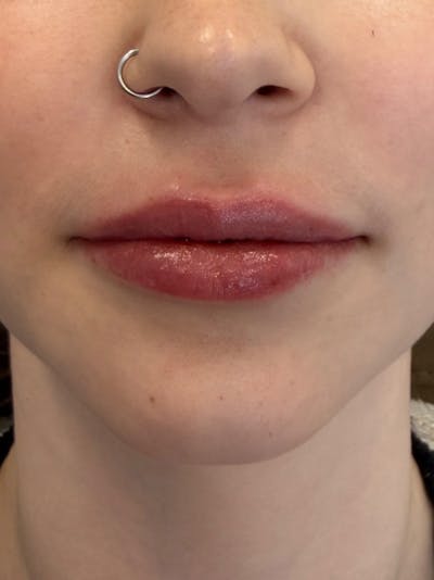 Lip Filler Before & After Gallery - Patient 740998 - Image 2