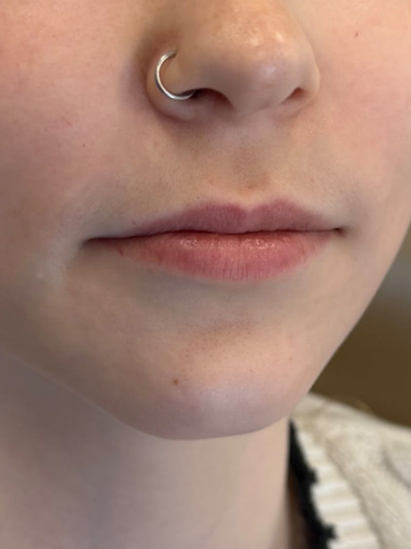 Lip Filler Before & After Gallery - Patient 740998 - Image 3