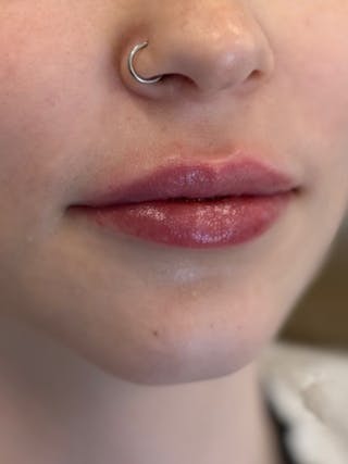 Lip Filler Before & After Gallery - Patient 740998 - Image 4