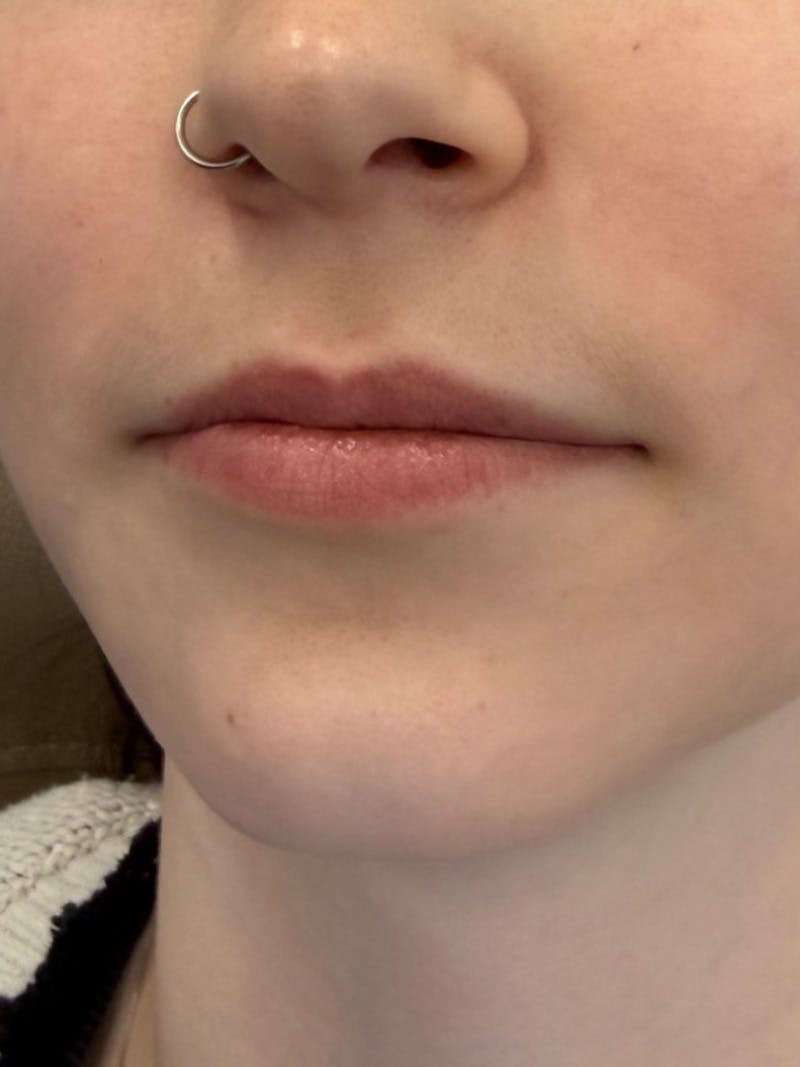Lip Filler Before & After Gallery - Patient 740998 - Image 5
