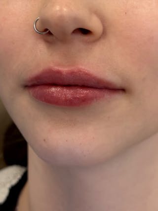 Lip Filler Before & After Gallery - Patient 740998 - Image 6