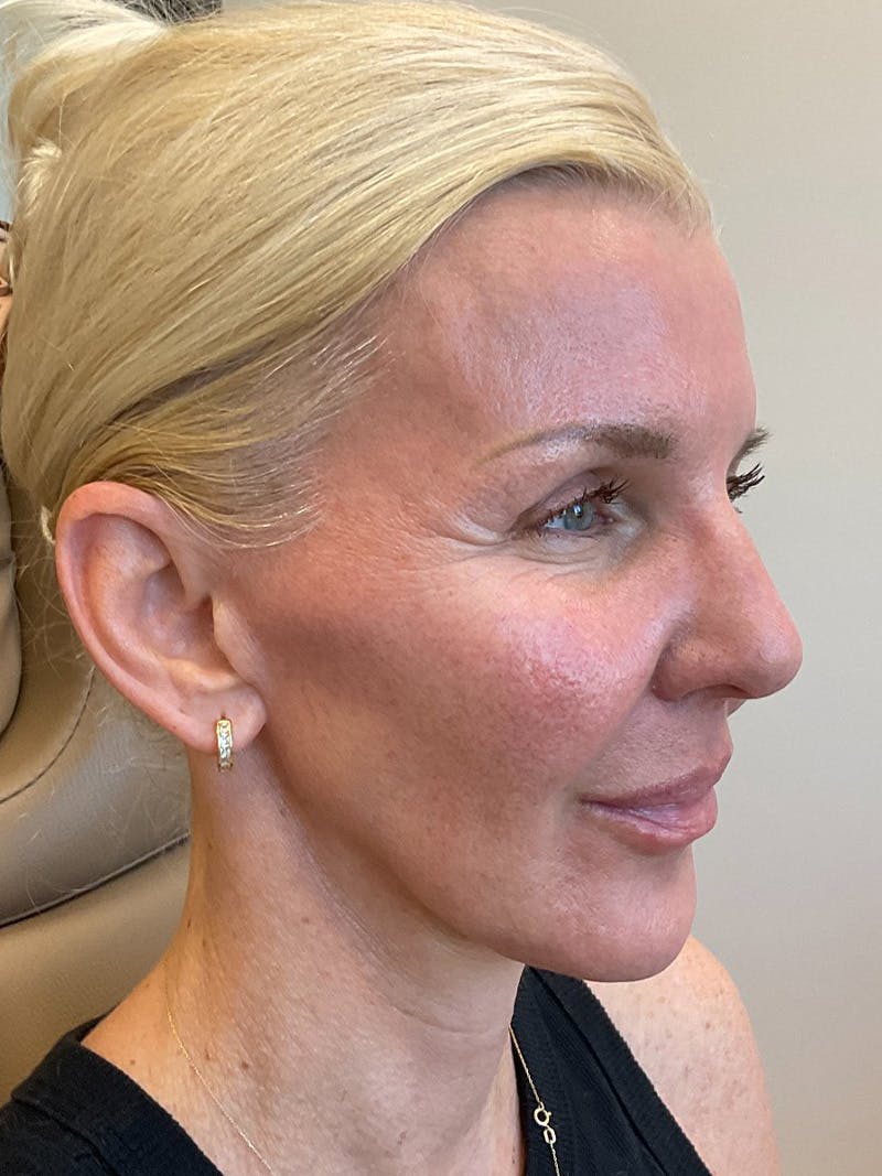 Jawline Contouring Before & After Gallery - Patient 292566 - Image 1