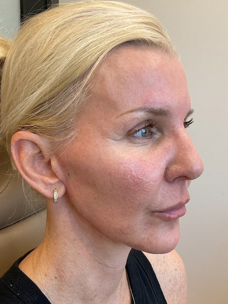 Jawline Contouring Before & After Gallery - Patient 292566 - Image 2