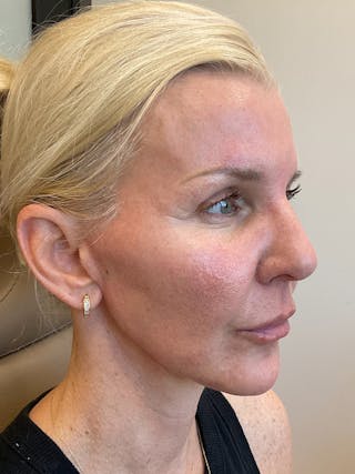 Jawline Contouring Before & After Gallery - Patient 292566 - Image 2